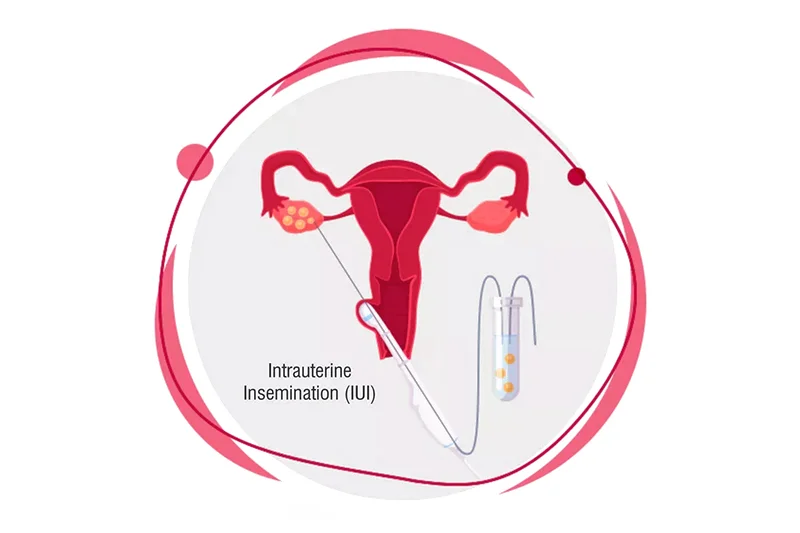 IUI