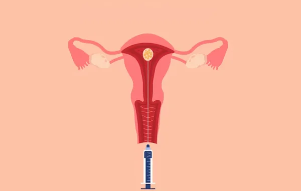 Frozen Embryo Transfer